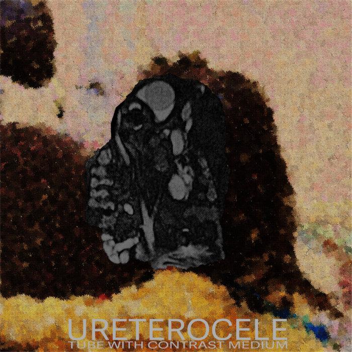 Tube With Contrast Medium - Ureterocele